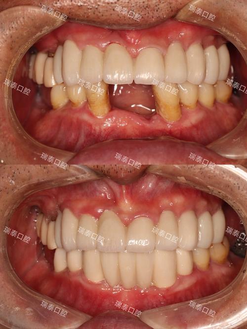 镶牙之后，为何需要换种牙？-图2