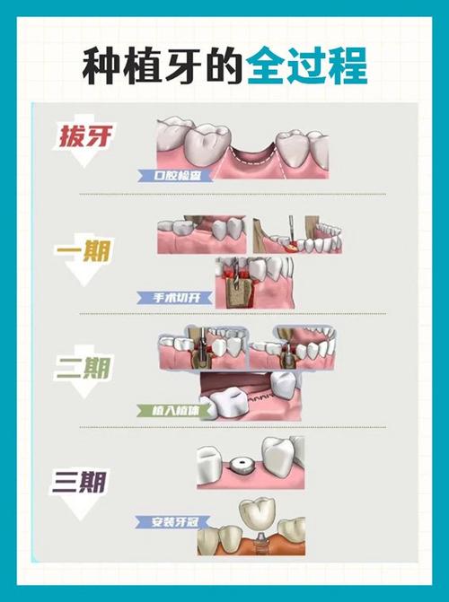 种牙过程及时间-图3