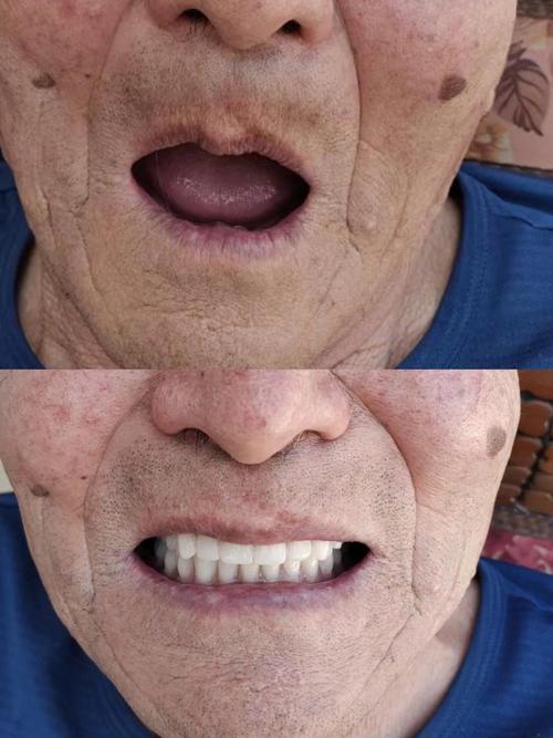 种牙没有愈合帽？会有什么影响吗？-图2