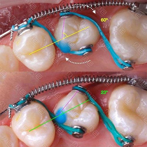 正畸戴弹簧的内收效果真的有效吗？-图1