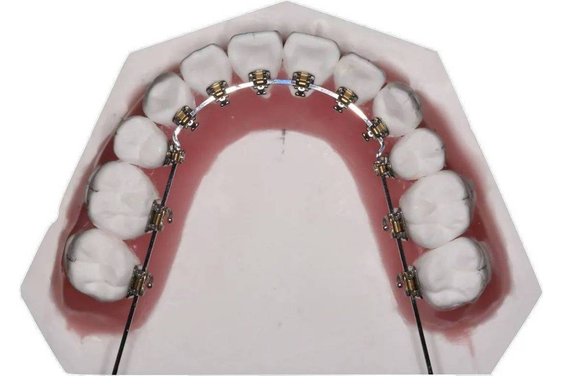 什么时候直弓丝正畸-图1