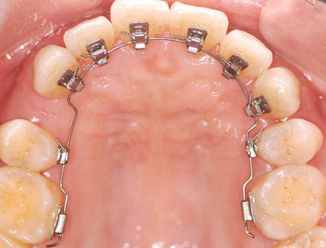 正畸舌挡是活动的吗-图1