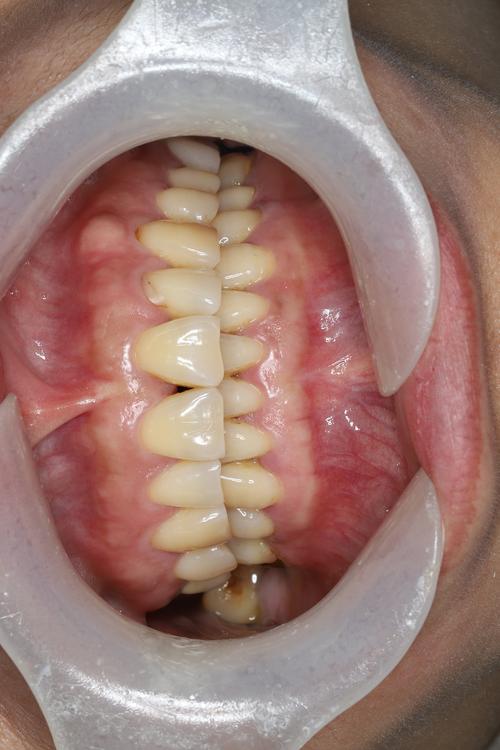 游离缺失不种牙，会有哪些不良后果？-图1