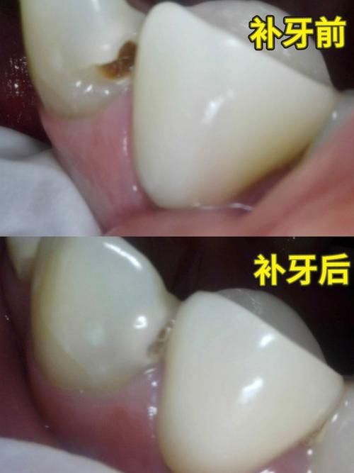 广州补牙和种牙有何不同？哪种更适合你？-图2
