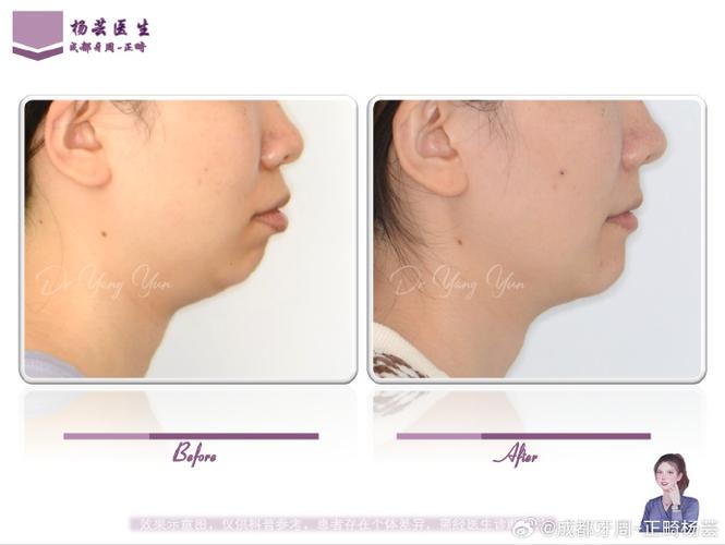 澳丝在正畸中的应用-图3