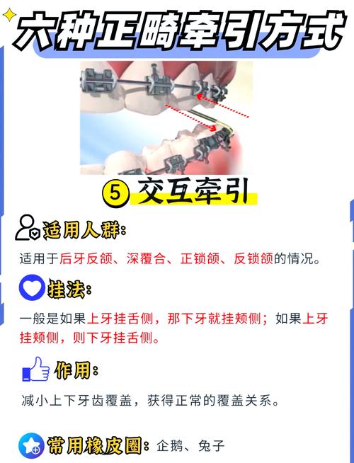 正畸牵引钩怎么弯制-图2