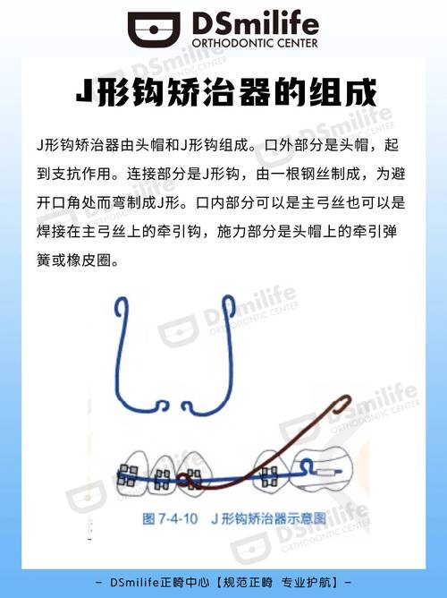 正畸牵引钩怎么弯制-图1