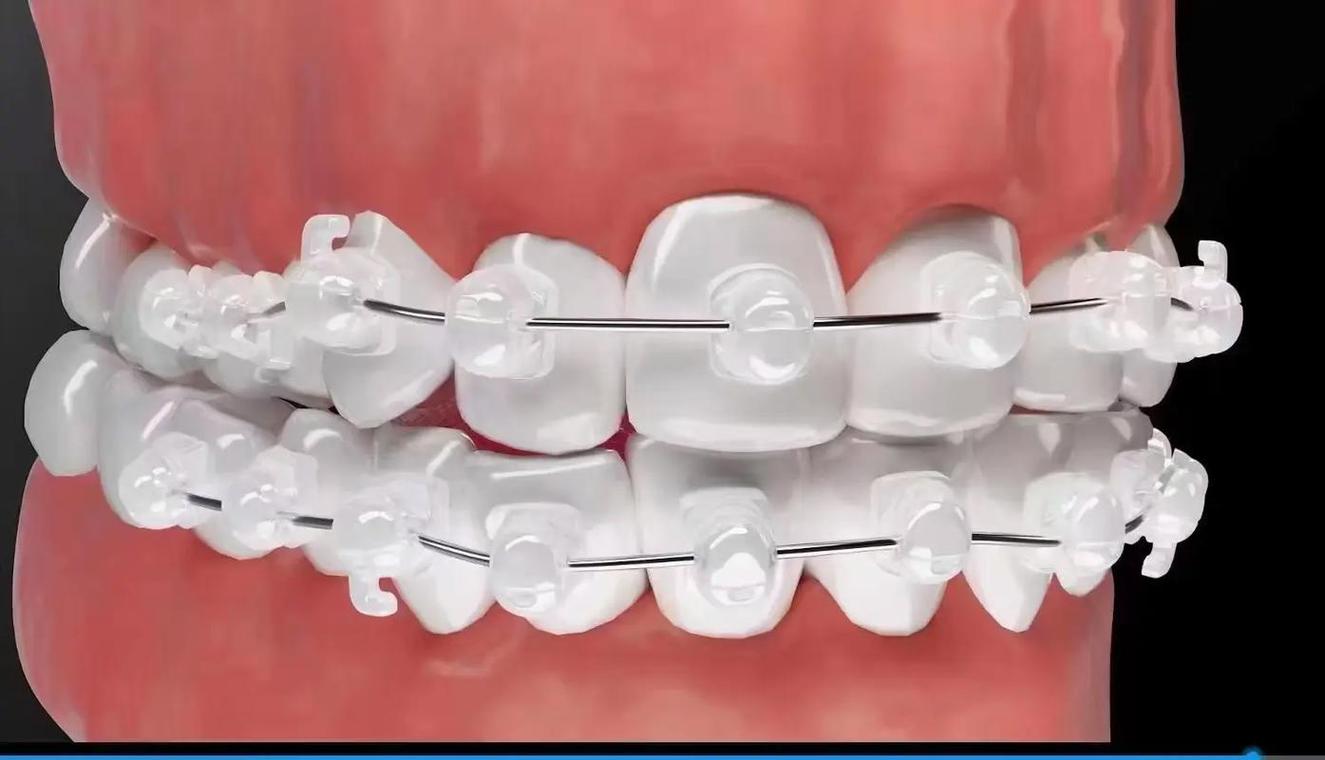 新亚正畸托槽怎么样-图2