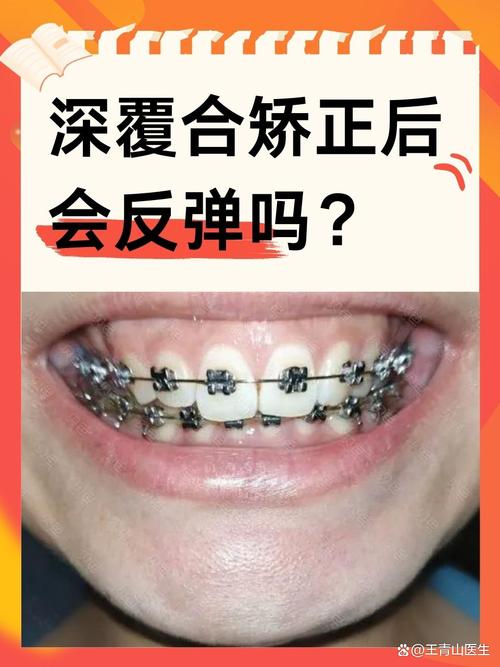 深覆盖适合做正畸吗-图2