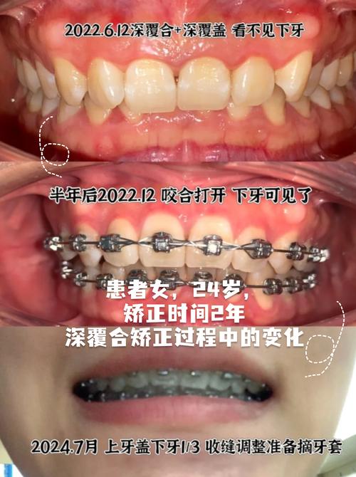 深覆盖适合做正畸吗-图1