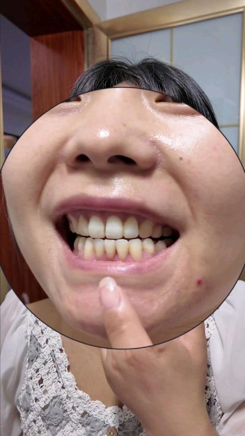 正畸后种牙周期多长？有哪些关键影响因素？-图1