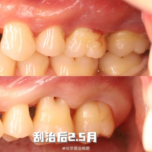 正畸后种牙周期多长？有哪些关键影响因素？-图2