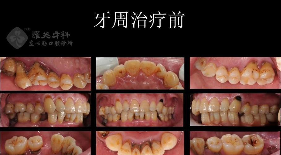 正畸后种牙周期多长？有哪些关键影响因素？-图3