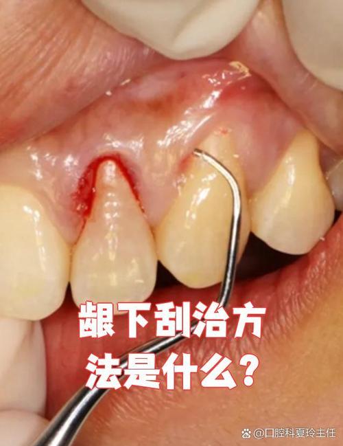 龈下刮治后多久能开始正畸？-图3