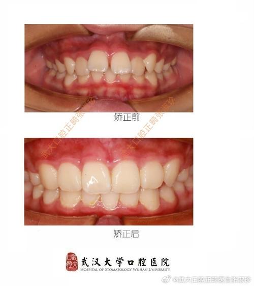 正畸深覆盖拔2颗牙-图2