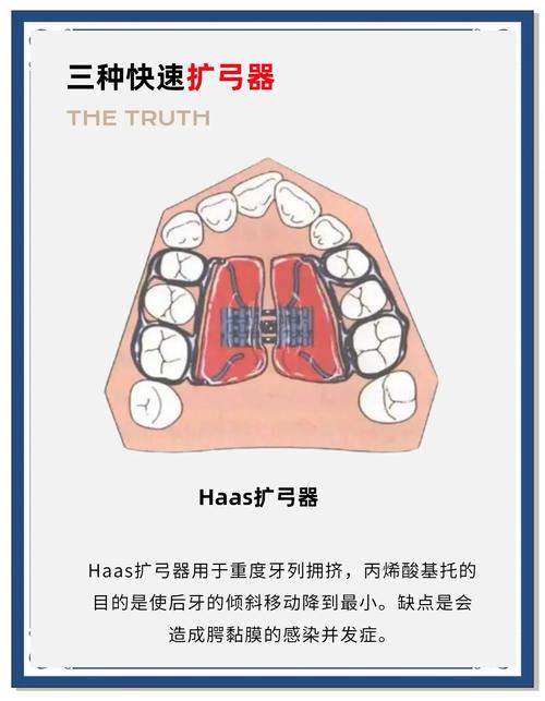 正畸扩弓有几种方法？哪种更适合不同情况？-图1