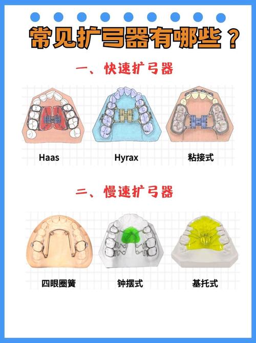 正畸扩弓有几种方法？哪种更适合不同情况？-图2