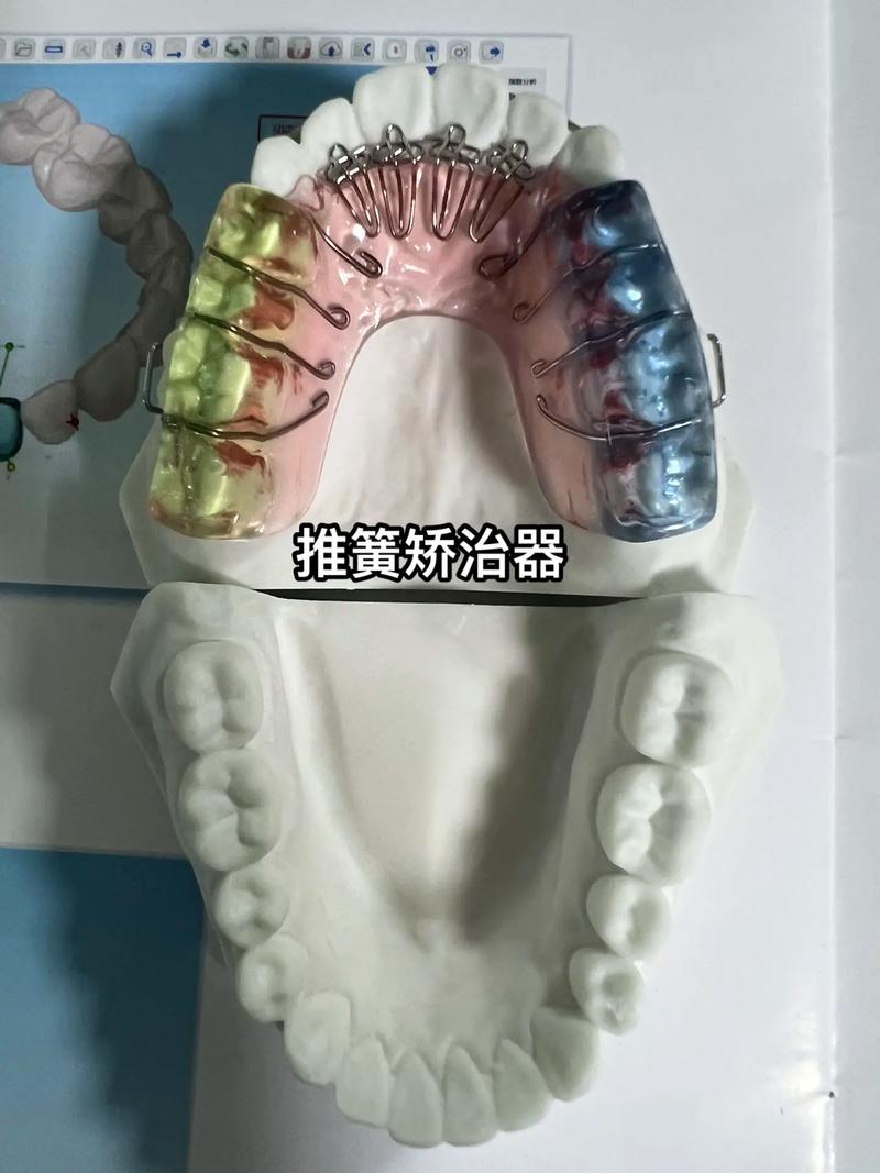 正畸推簧什么时候用-图1