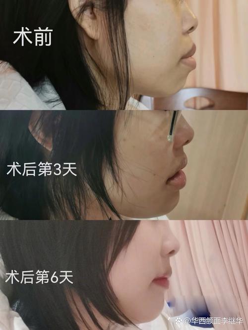 正颌手术不需要正畸-图2