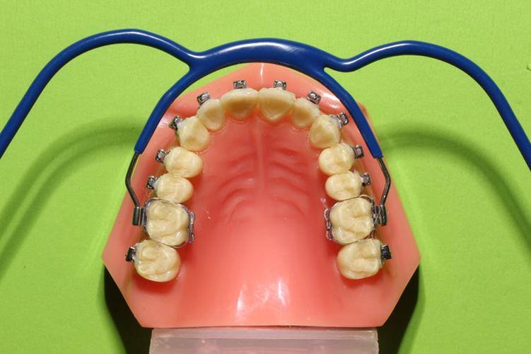 正畸口外弓的适应症-图1