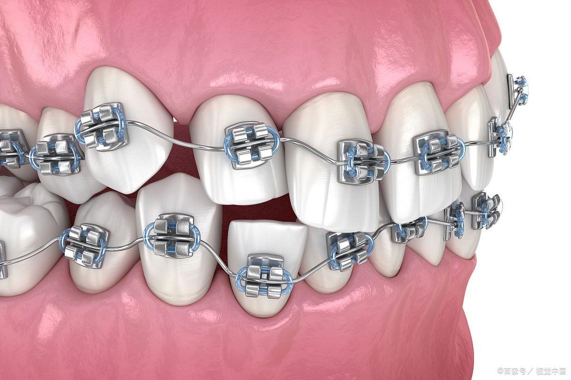 融合牙正畸KQ88-图1