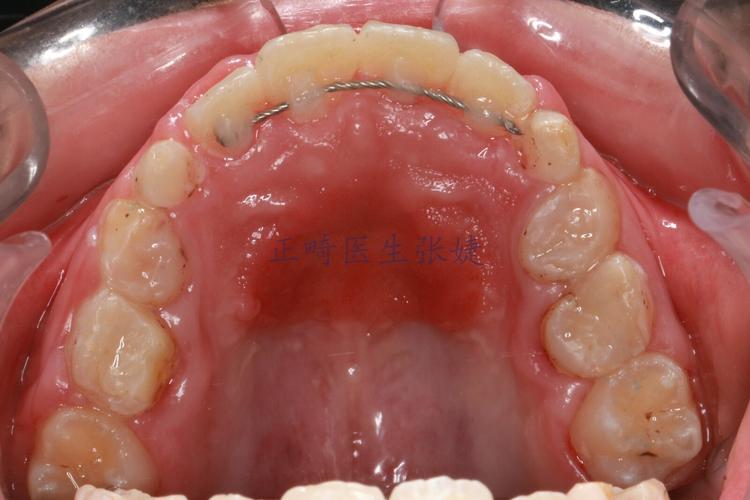 牙齿正畸把牙拉出来-图1