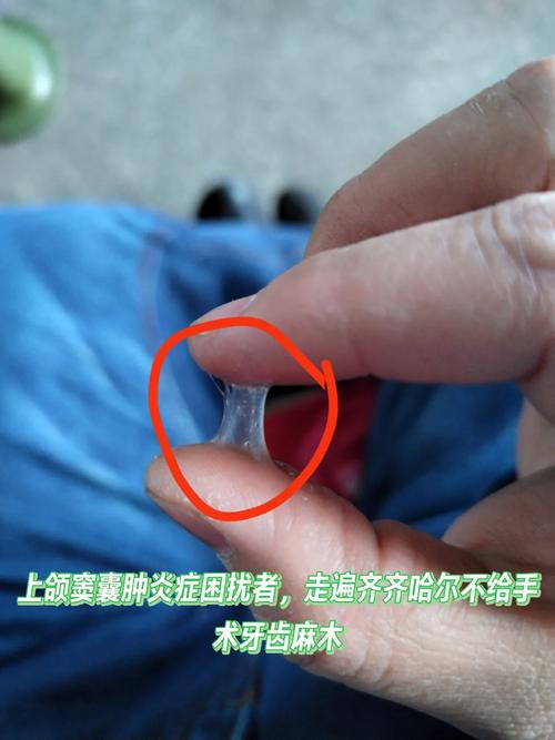 种牙后上颌窦感染？原因与应对方法需了解？-图1