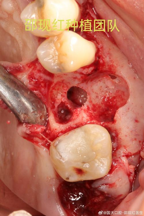 种牙后上颌窦感染？原因与应对方法需了解？-图2