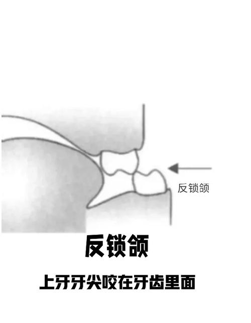咬颌在正畸中的意义-图2 咬颌在正畸中的意义-图2
