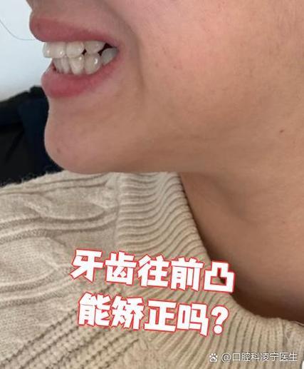 一颗大牙往外突影响美观,正畸矫正能改善吗?-图3 一颗大牙往外突影响美观,正畸矫正能改善吗?-图3