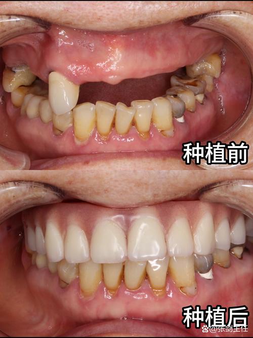 45号牙齿种牙-图3 45号牙齿种牙-图3