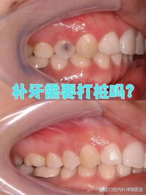 补牙打桩和种牙，牙齿修复该如何正确选择？-图1