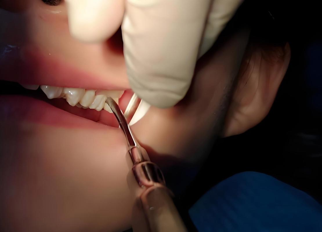 宁波拔牙与种牙-图2