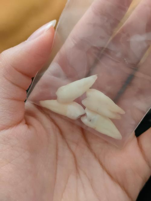 拔了四个牙，为何最终放弃正畸？-图2