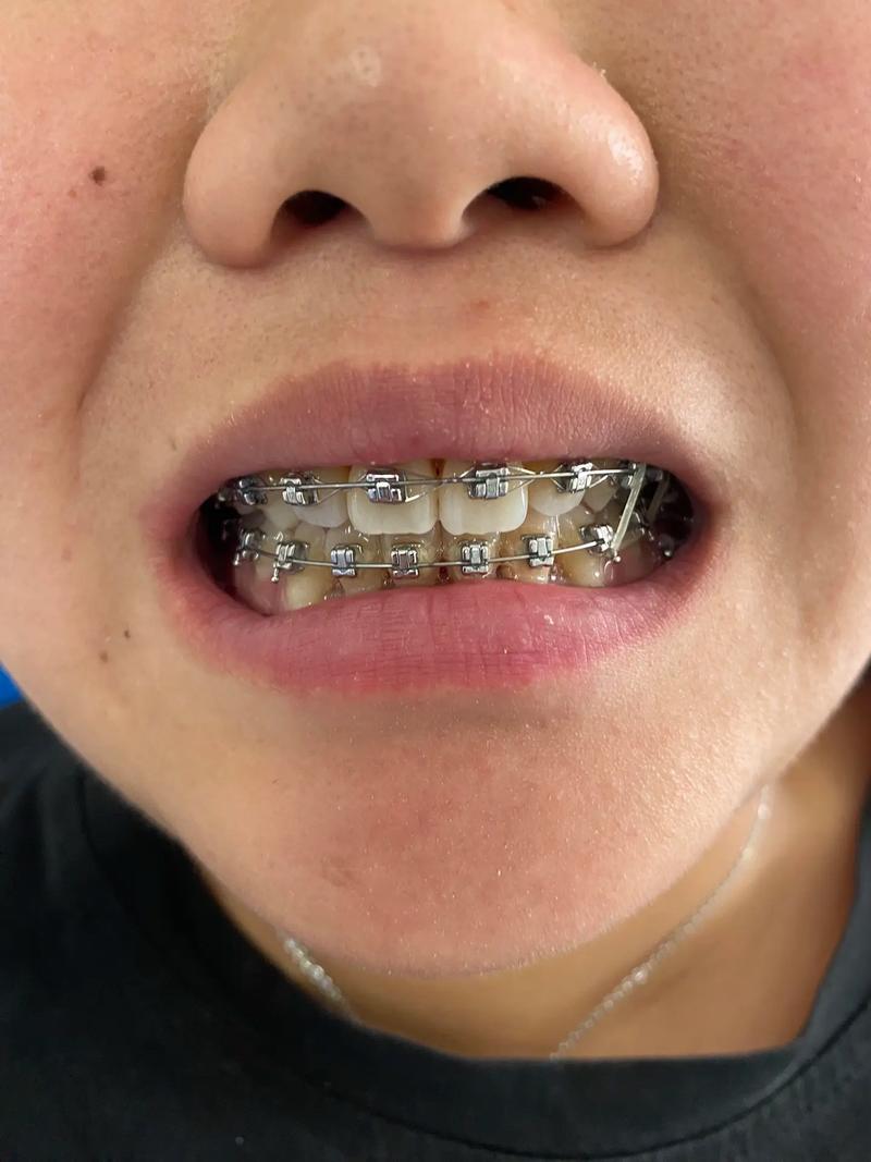 拔了四个牙，为何最终放弃正畸？-图1