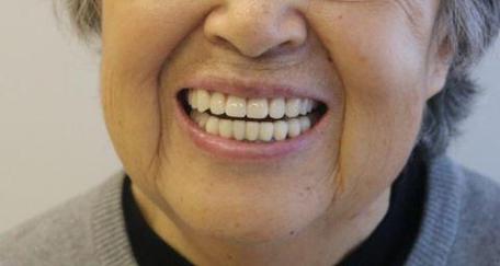 65岁以上种牙安全吗?效果能维持多久?-图2 65岁以上种牙安全吗?效果能维持多久?-图2