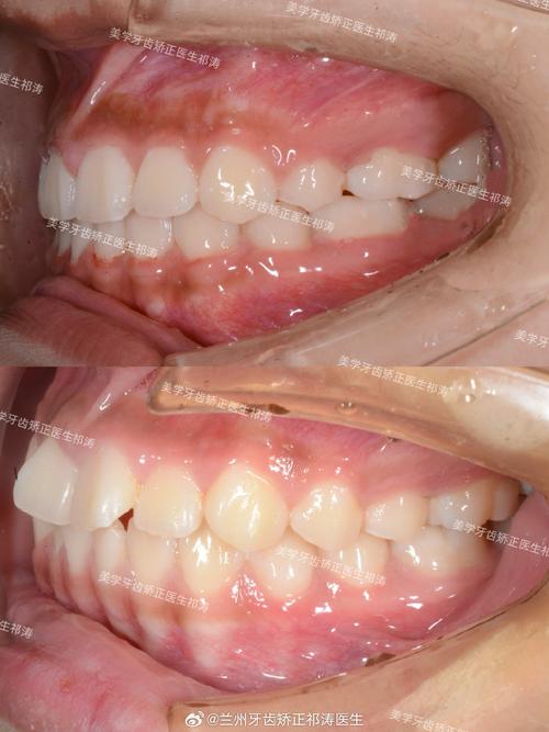 隐适美正畸牙齿没齐-图2