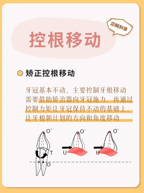 正畸控根簧弯制方法-图2