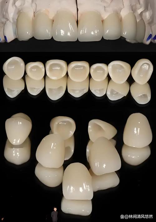 种牙前为何要戴义牙？作用与必要性是什么？-图2