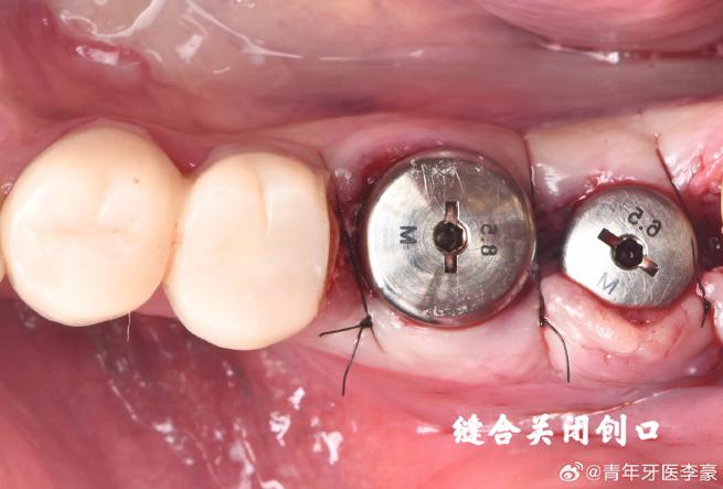 植骨种牙邻牙松-图3