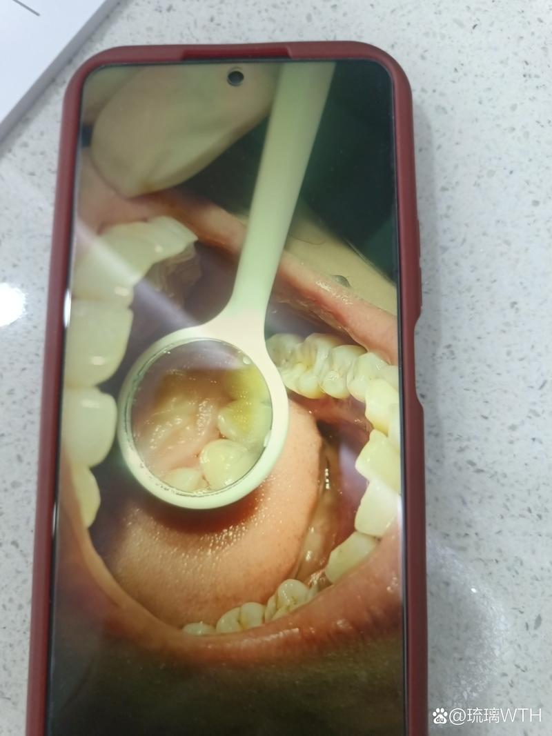 牙博士洗牙有两种，哪种更适合你的牙齿状况？-图3