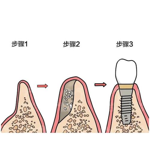 少颗牙要种牙吗-图2
