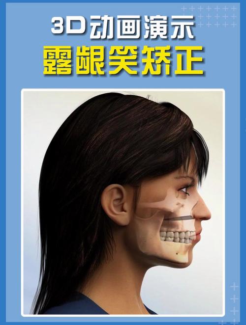 正畸露龈笑矫正时间-图1