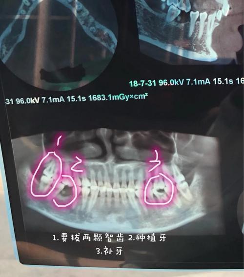 瑞士种牙 拆线-图2