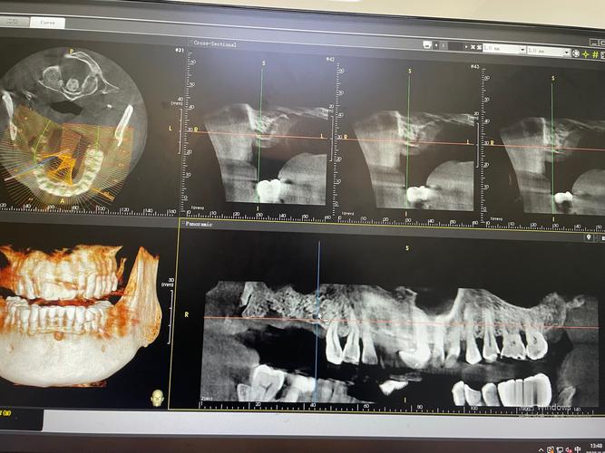 瑞士种牙 拆线-图1