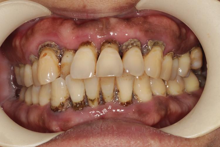 慢性牙周病种牙前必须先治疗吗？-图1