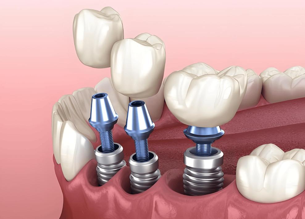 百万医疗 种牙-图2