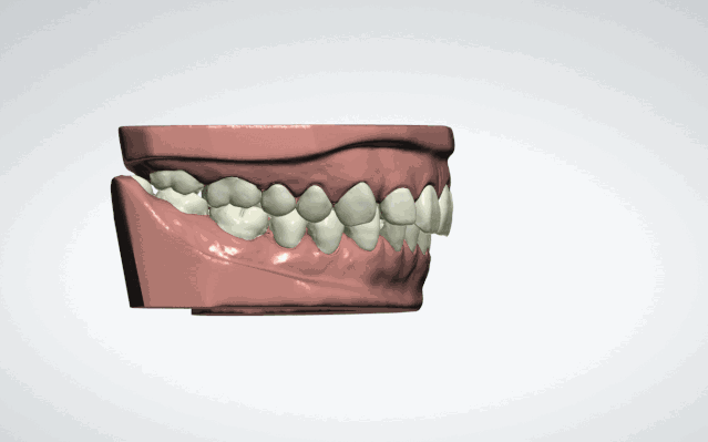 正畸牙齿移动动态图-图2