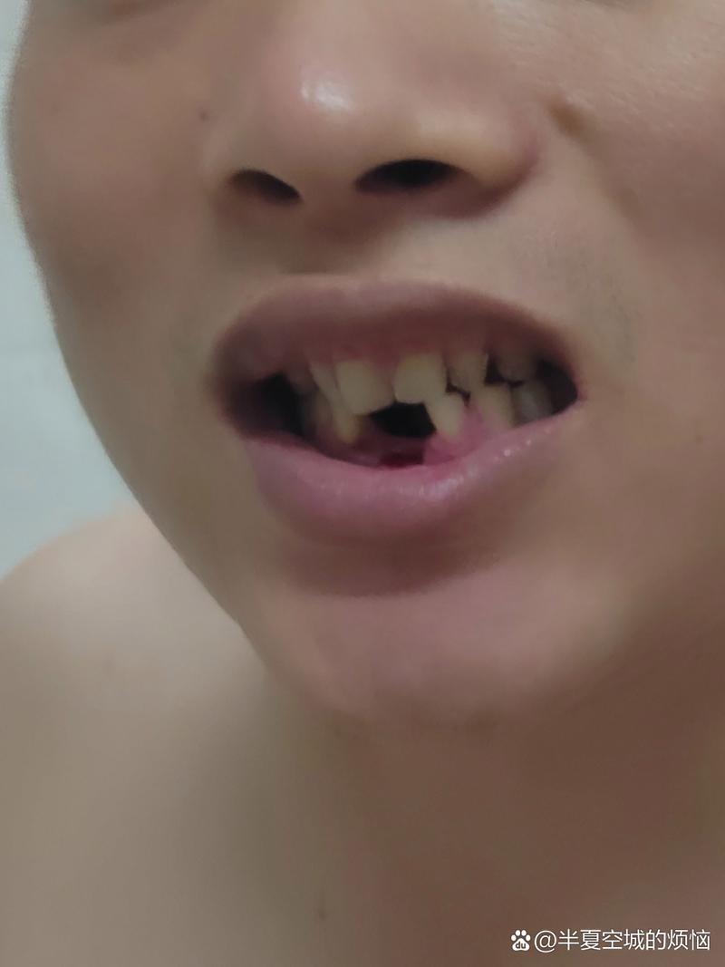 牙齿掉了 种牙-图3