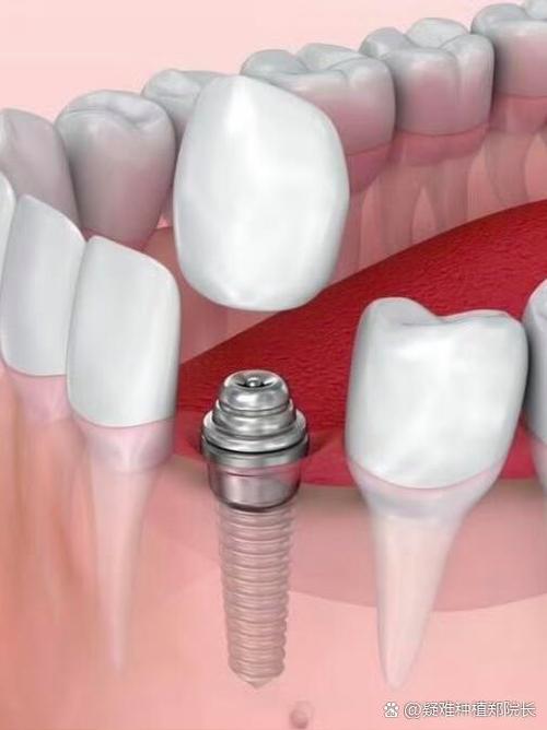 种牙 德国系统-图2